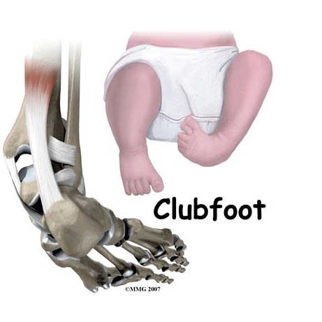 Clubfoot is a foot deformity in which a child is born with feet twisted inwards 